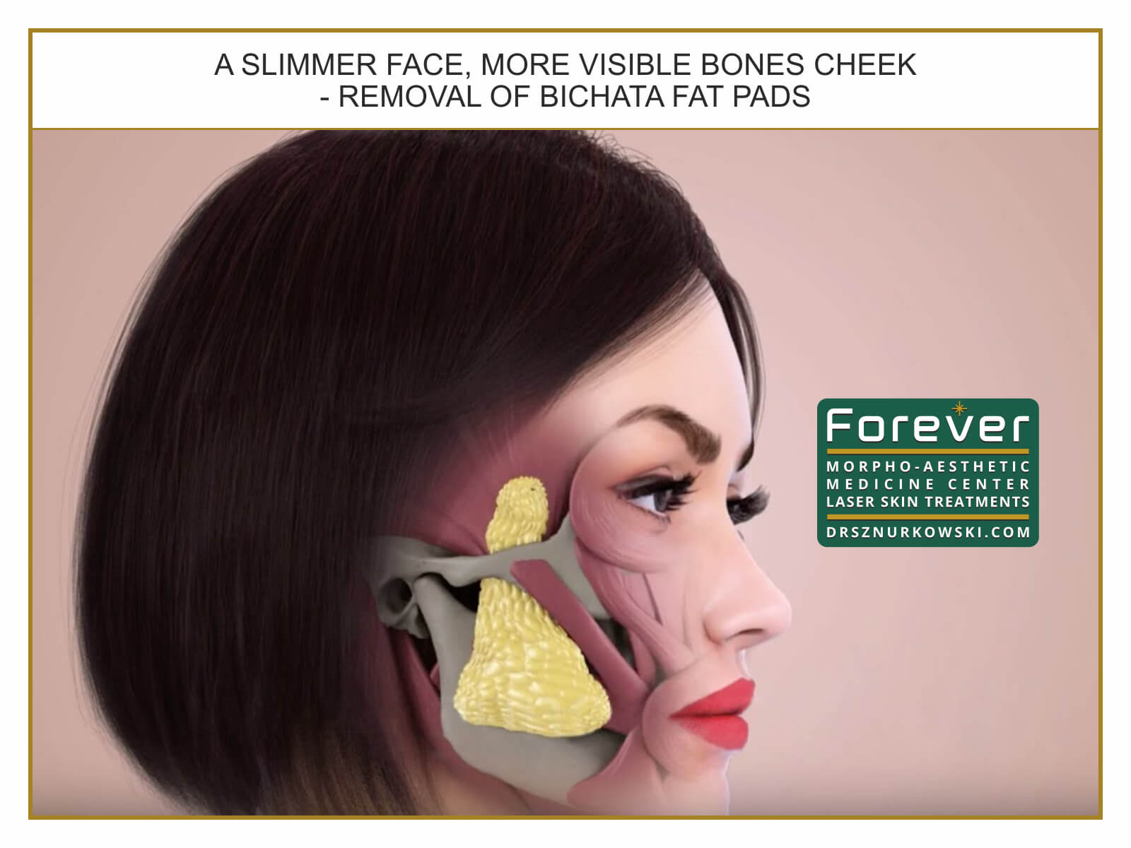 A Slimmer Face, More Visible Bones Cheek - Removal of Bichata...2 (80x60) EN.jpg