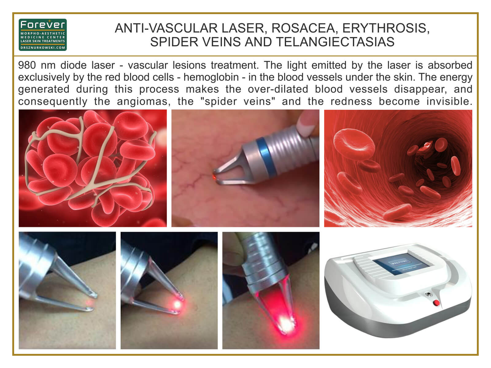Anti-Vascular Laser, Rosacea, Erythrosis, Spider Veins... (80x60) EN.jpg