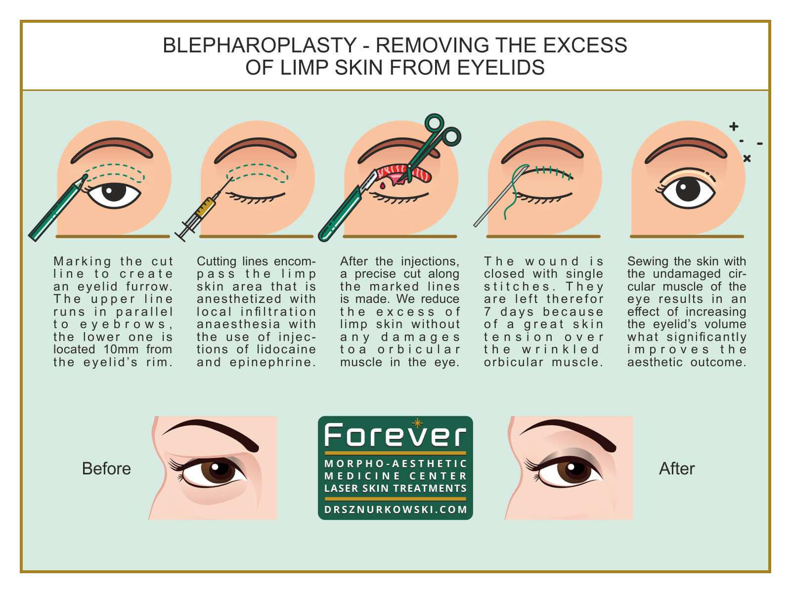 Blepharoplasty - Removing The Excess of Limp Skin From Eyelids (80x60) EN.jpg
