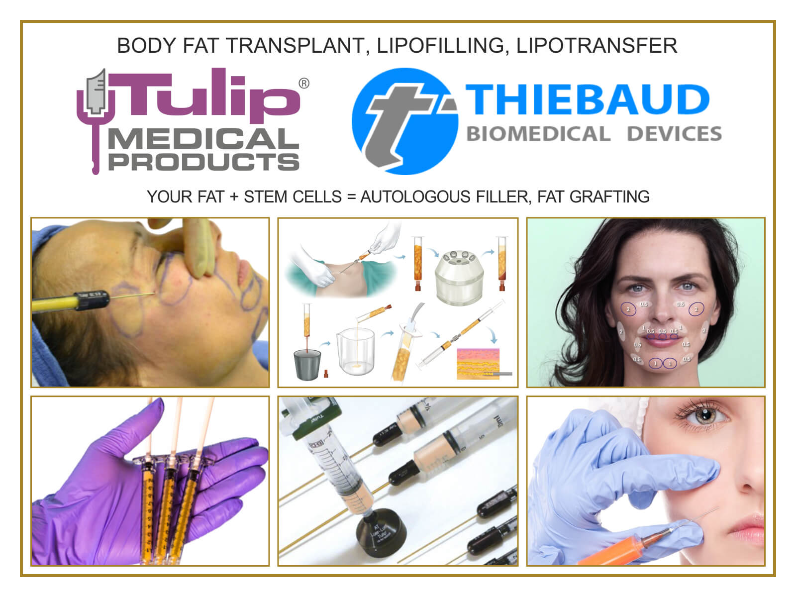 Body Fat Transplant, Lipofilling, Lipotransfer (80x60) EN.jpg