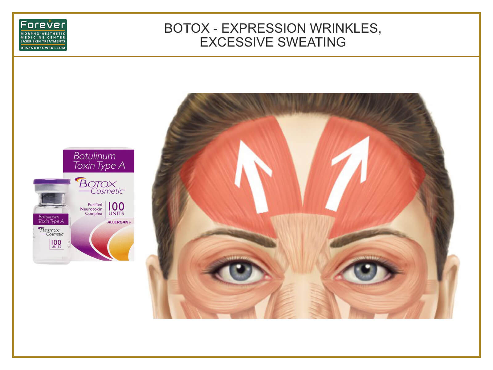 Botox - Expression Wrinkles, Excessive Sweating (80x60) EN.jpg