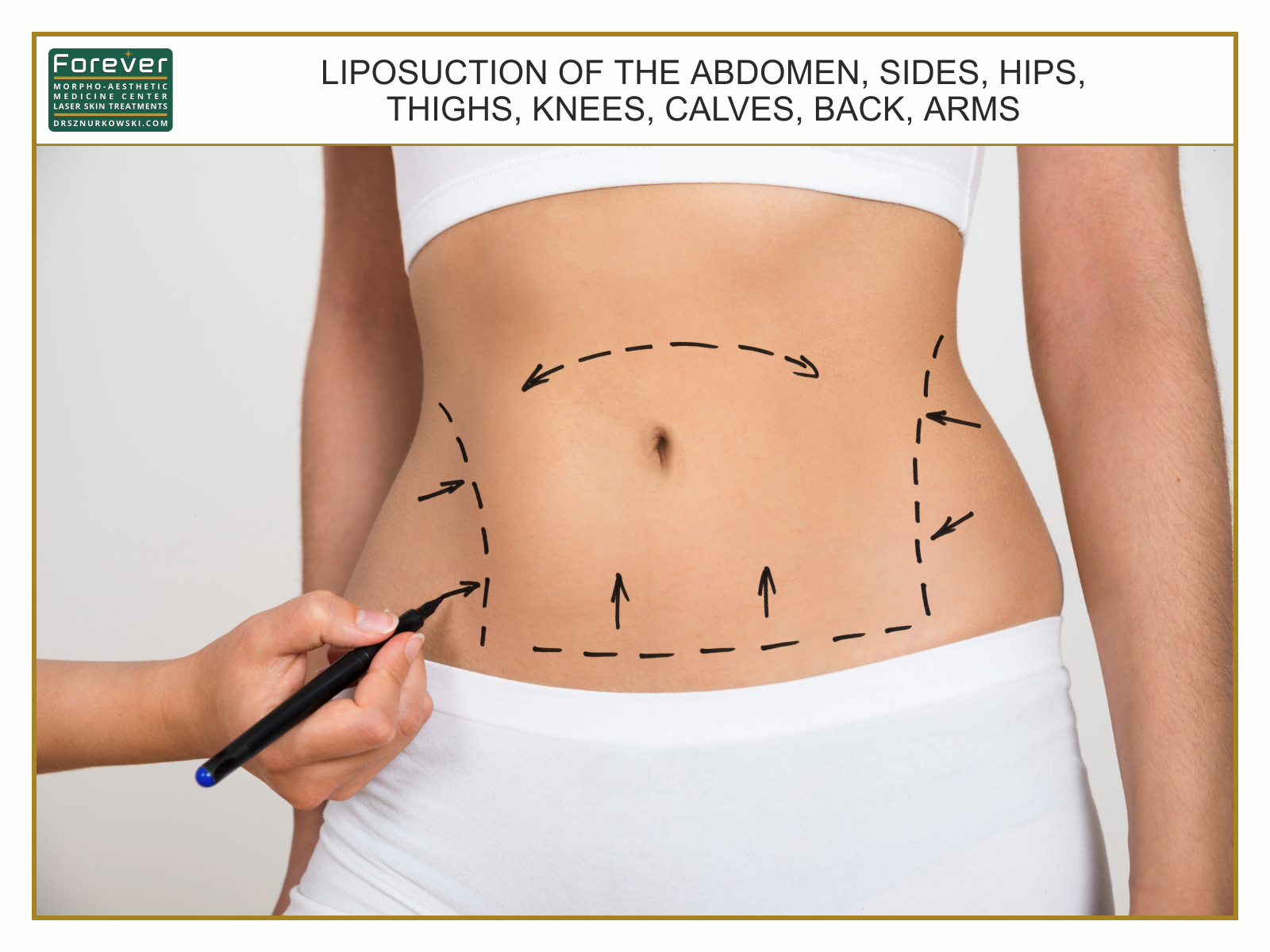 Liposuction of the Abdomen, Sides, Hips, Thighs, Knees, Calves, Back, Arms.jpg