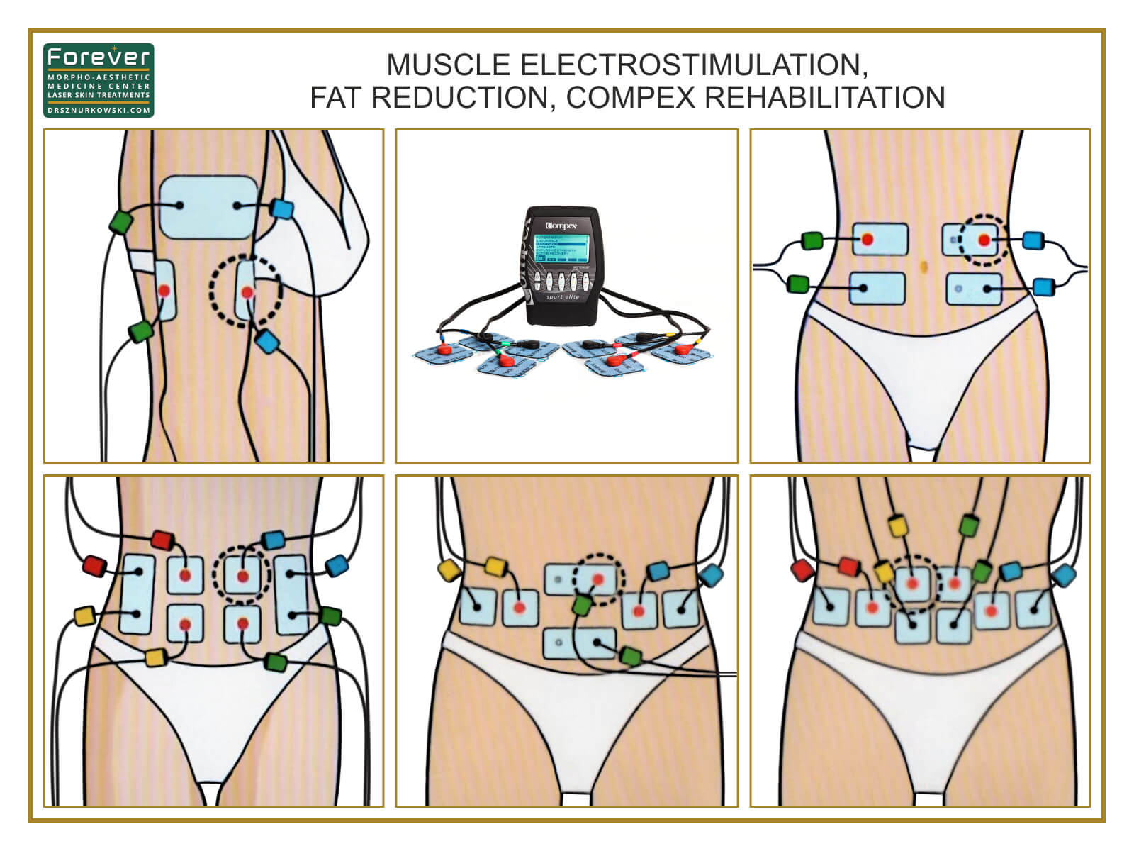 Muscle Electrostimulation, Fat Reduction, Compex Rehabilitation (80x60) EN.jpg
