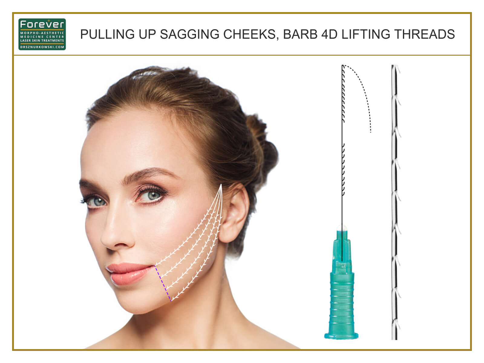 Pulling Up Sagging Cheeks, Barb 4D Lifting Threads (80x60) EN.jpg