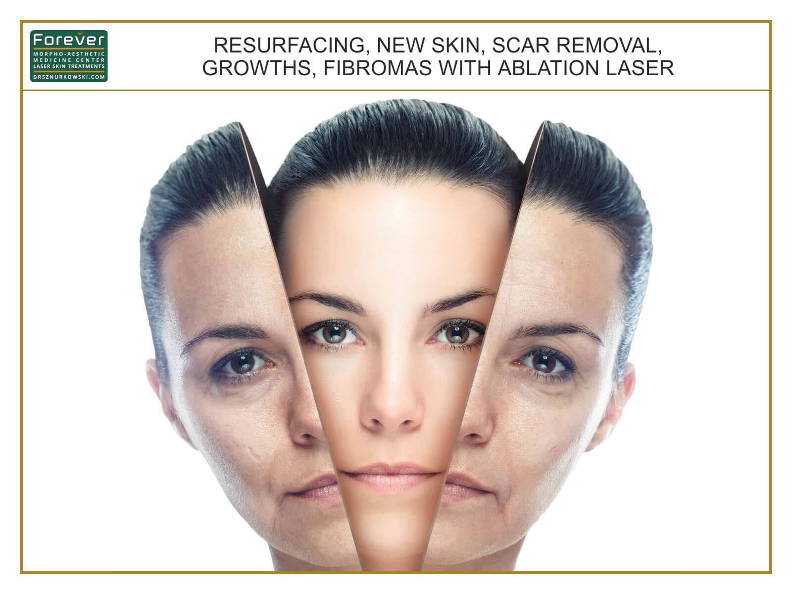 Resurfacing, New Skin, Scar Removal, Growths, Fibromas... (80x60) EN.jpg