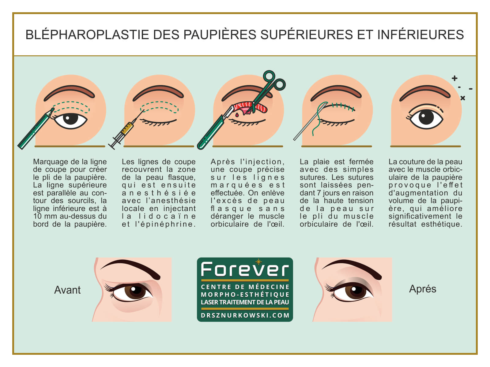Blepharoplasty - Removing The Excess of Limp Skin From Eyelids (80x60) FR.jpg