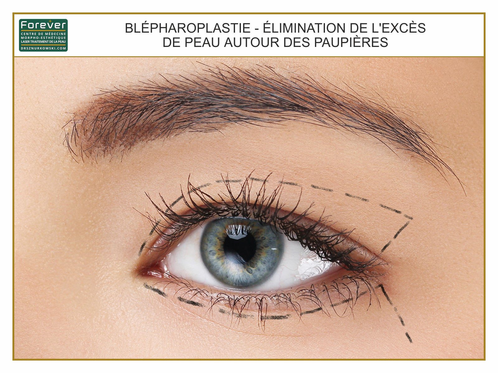 Blepharoplasty - Removing The Excess of Limp Skin From Eyelids 2 (80x60) FR.jpg