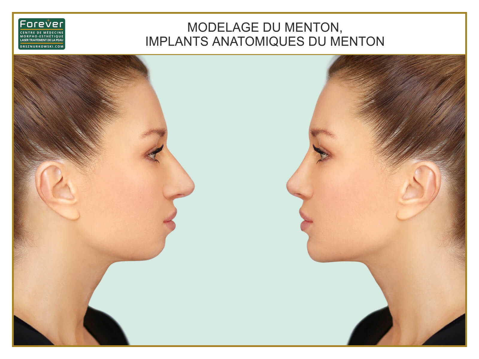 Facial Slimming, Anatomical Implants, Chin Augmentation (80x60) FR.jpg