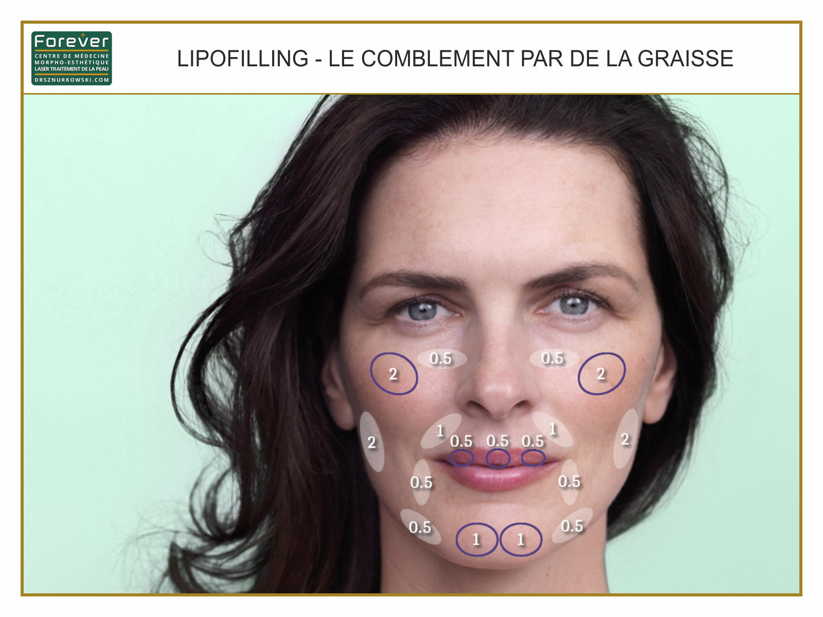 Lipofilling - Facial Filling With Fat (80x60) FR.jpg