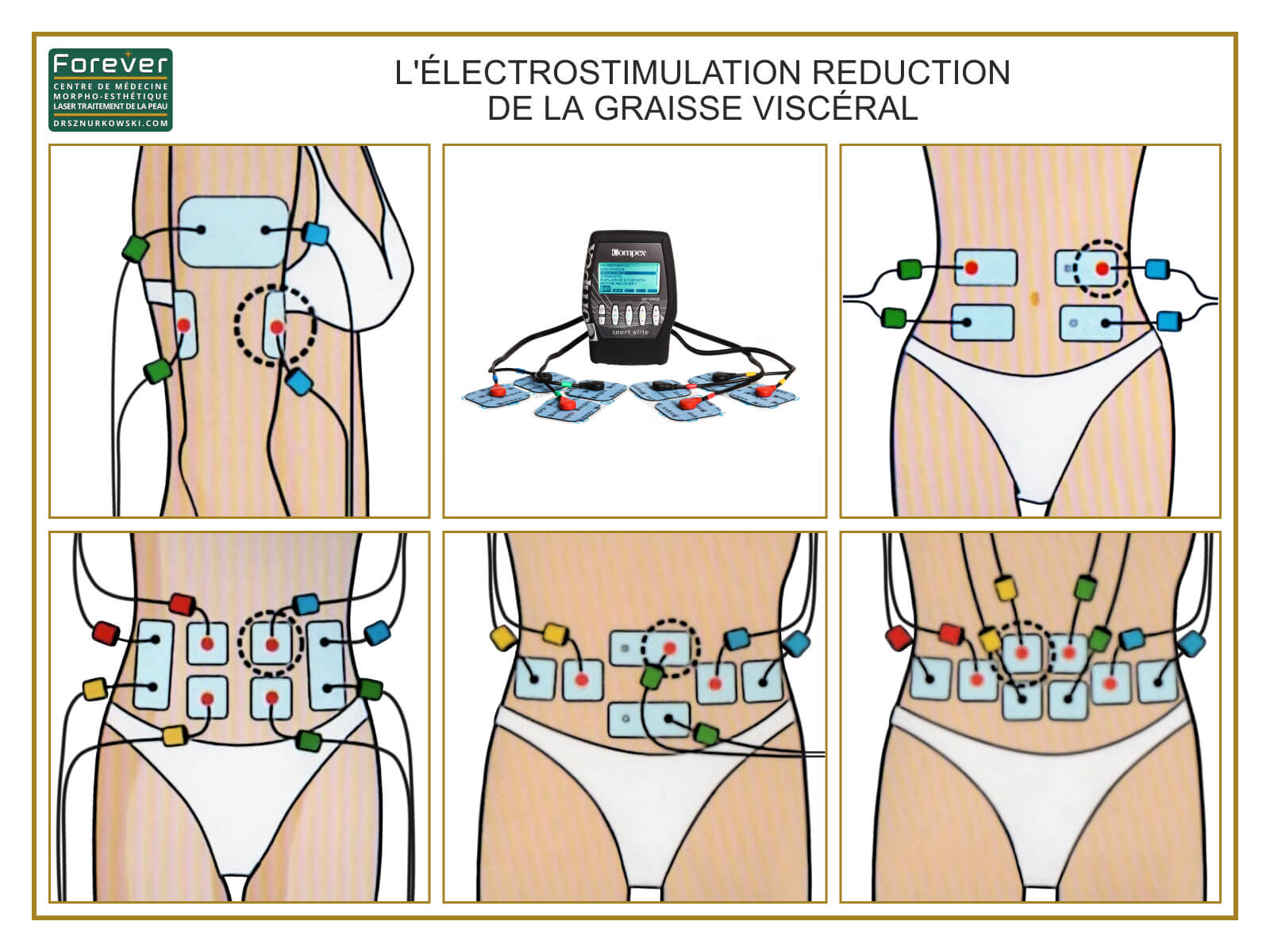Muscle Electrostimulation, Fat Reduction, Compex Rehabilitation (80x60) FR.jpg