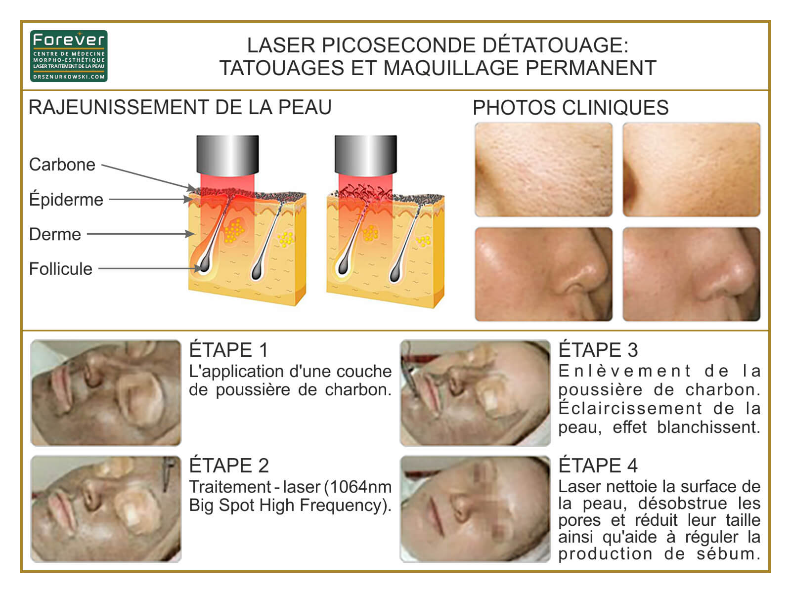 Permanent Make-up And Melasma Removal, Spots, Picosecond... (80x60) FR.jpg