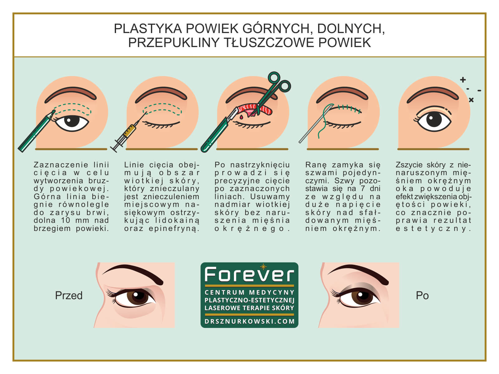 Blepharoplasty - Removing The Excess of Limp Skin From Eyelids (80x60) PL.jpg