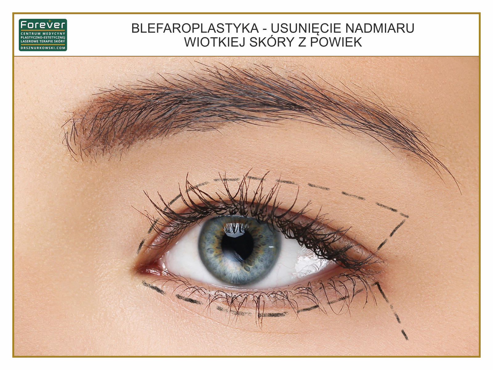 Blepharoplasty - Removing The Excess of Limp Skin From Eyelids 2 (80x60) PL.jpg
