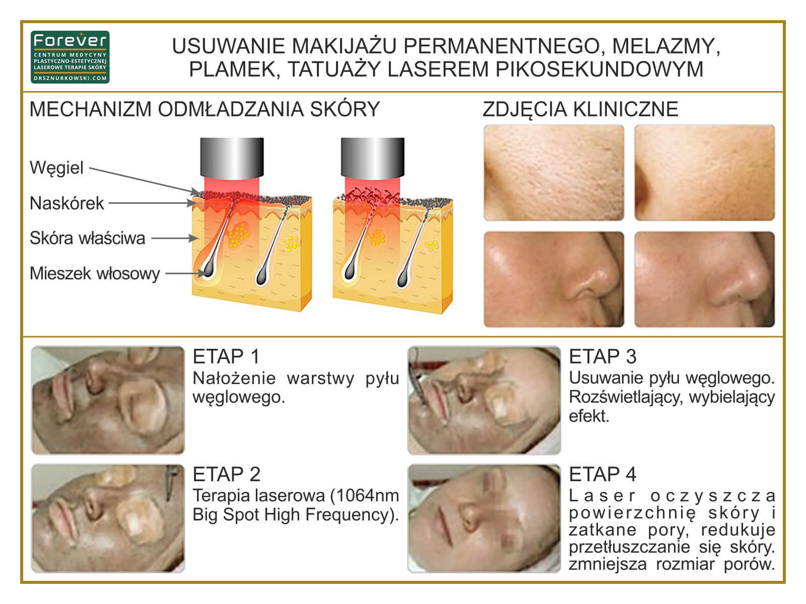 Permanent Make-up And Melasma Removal, Spots, Picosecond... (80x60) PL.jpg
